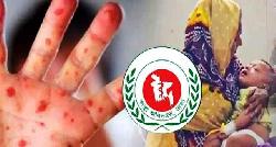 হাম ও হামের উপসর্গ নিয়ে আরও ৩ জনের মৃত্যু